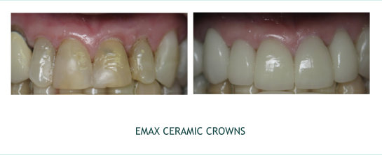 Emax Ceramic Crowns 1