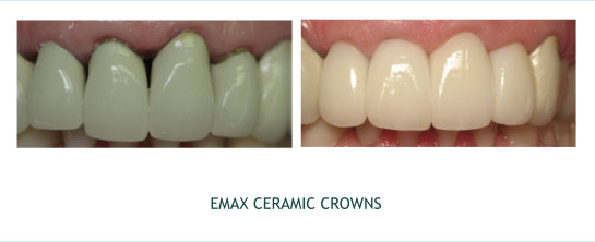 Emax Ceramic Crowns 2