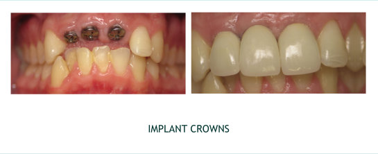 Implant Crowns