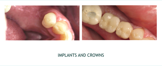 Implants and Crowns